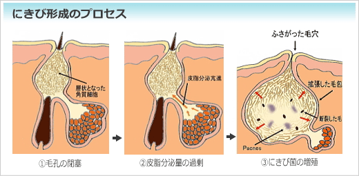 にきび治療にピルが効くって本当 毛穴パックで毛穴が拡大 その対処方法を教えます